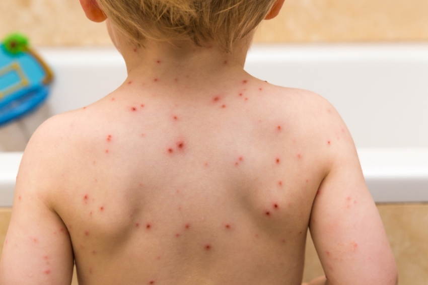 U Nišu prijavljena epidemija malih boginja