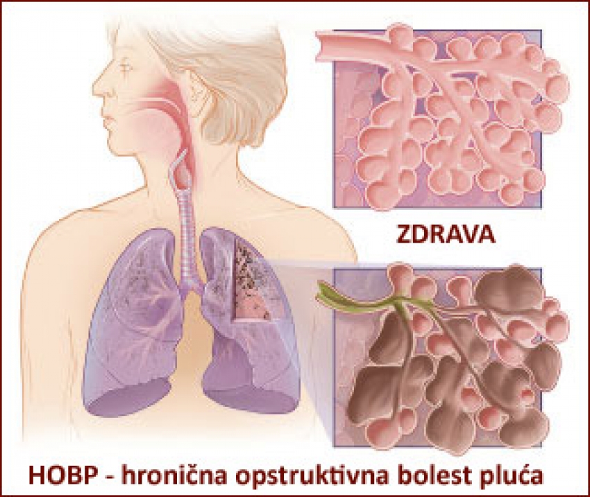 Kotorani dobijaju besplatan pregled pluća