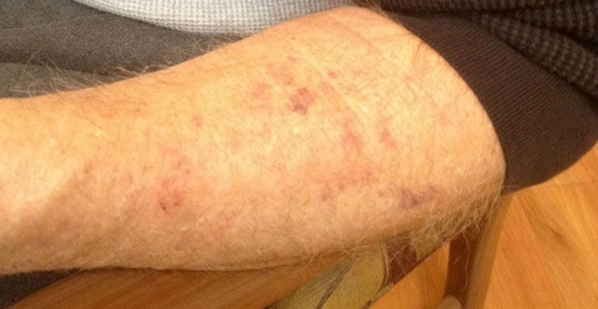Jedan slučaj sifilisa, 77 osoba imalo šugu