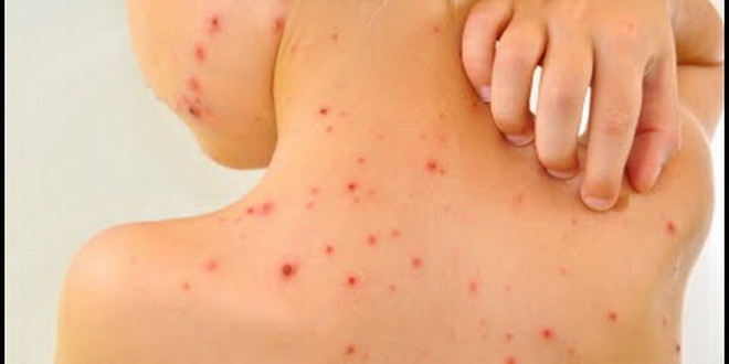 U slučaju epidemije razmišlja se o vakcinaciji djece mlađe od 12 mjeseci