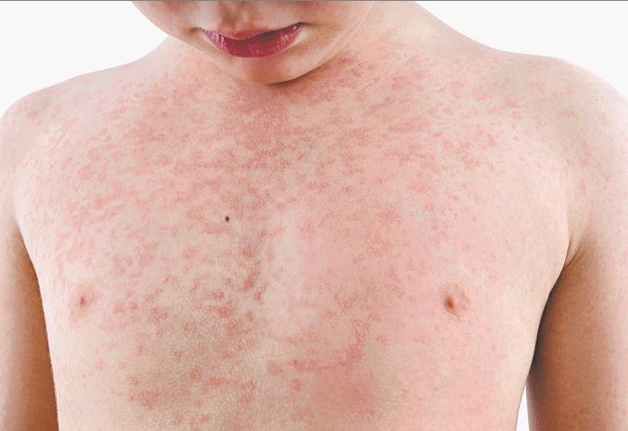 Institut za javno zdravlje: U Crnoj Gori još uvijek nije proglašena epidemija morbila