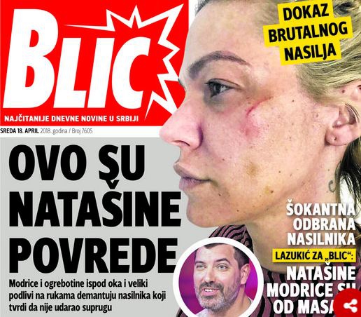 FOTO – Ovako izgleda Nataša Bekvalac nakon što je muž istukao