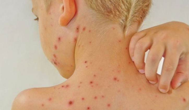 Proglašena epidemija morbila u Banjaluci