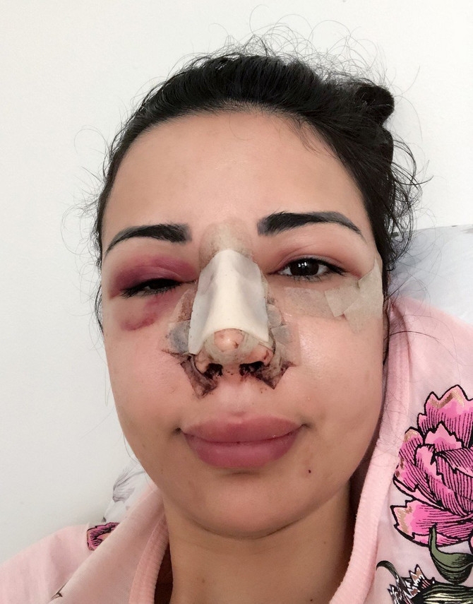 30 OPERACIJA da bi ličila na Kim Kardašijan: Da li joj je uspjelo?