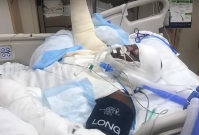 Poliju se alkoholom, pa se zapale! Djevojčica izgorela zbog izazova koji među djecom kruži internetom