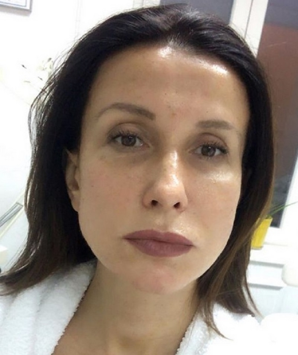 Snežana Dakić nakon VAMPIRSKOG TRETMANA pokazala lice…