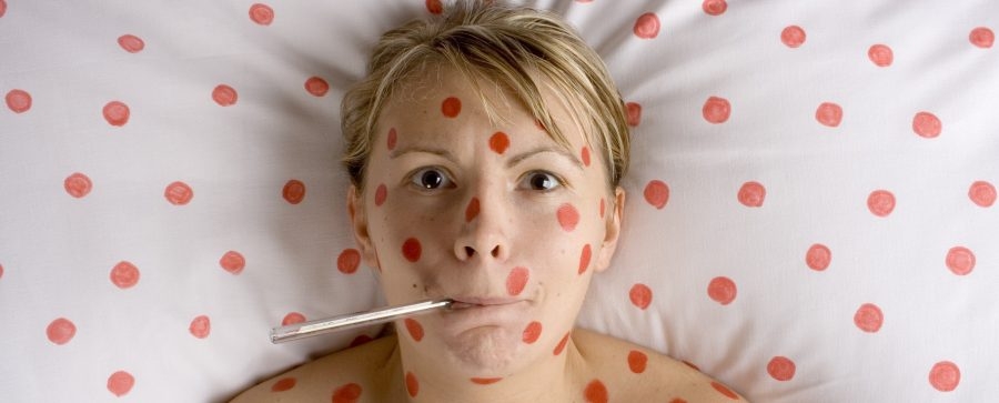 Nema epidemije: Od početka godine 3.137 oboljelih od varičele