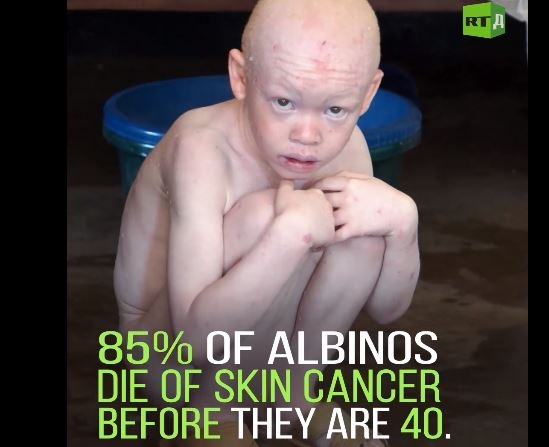 Sjeku ih na komade pa dijelove tijela prodaju vračarama, tužna sudbina albino ljudi