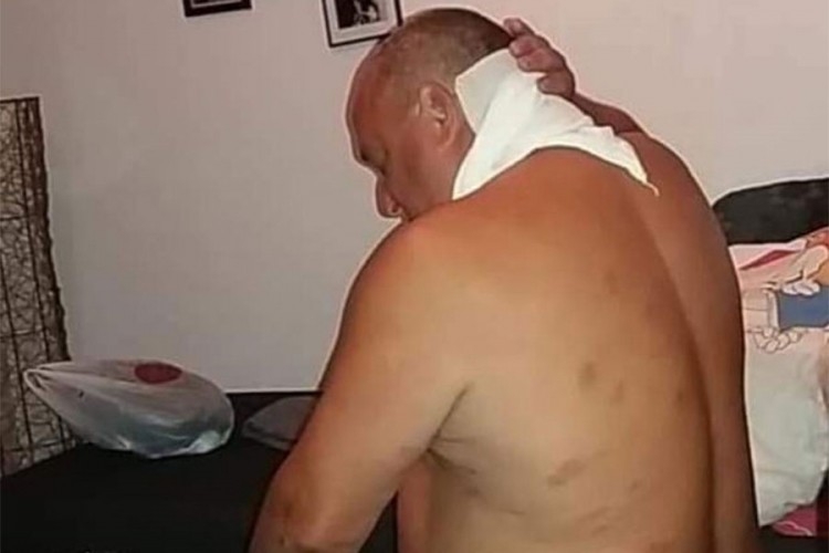 Medicinski fenomen: Drvosječa preživio čak 67 uboda stršljenova