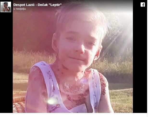 Teška i rijetka bolest: “Dječak leptir” iz Bajine bašte se bori za život