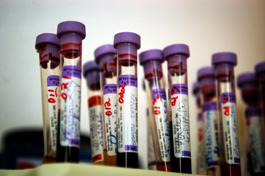 PODACI IJZ: 90 odsto inficiranih HIV-om su muškarci