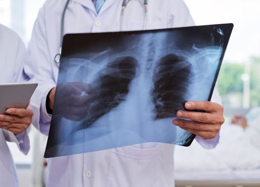 Načelnica pulmologije Interne klinike: Covid-19 izaziva upale pluća sa kojima se nismo do sada suočavali