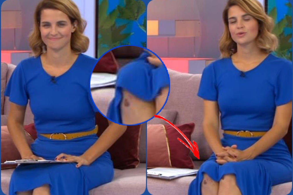Doris Pinčić u emisiji sva u modricama, gledaoci zabrinuti (FOTO)