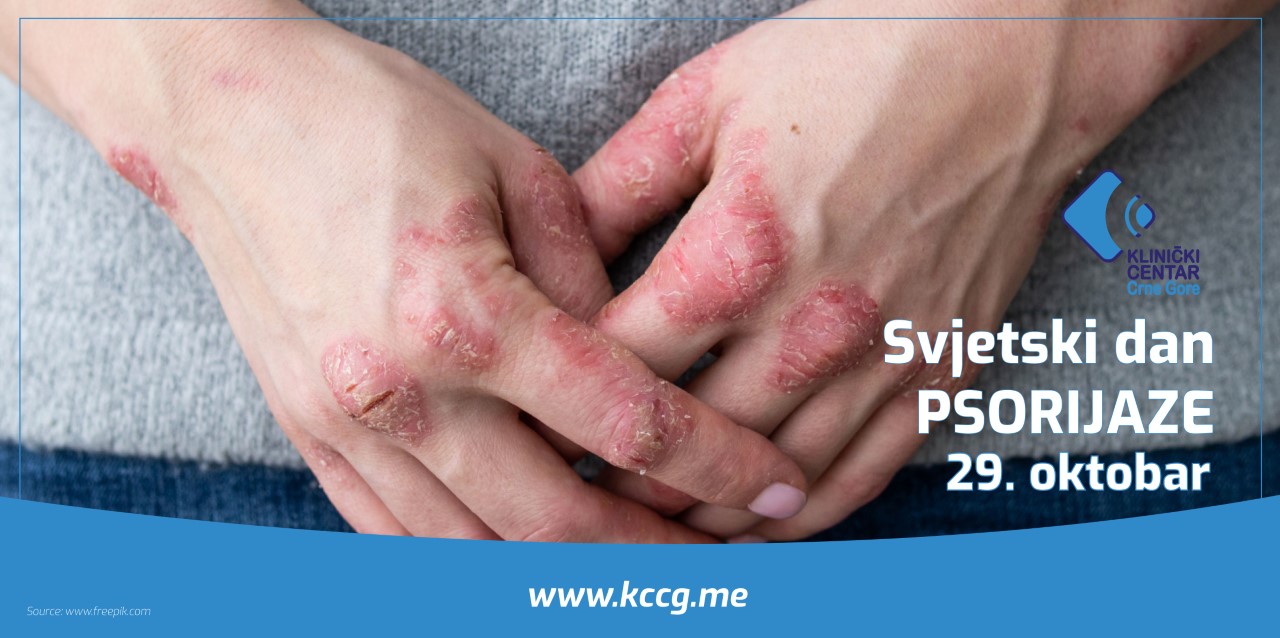 KCCG obilježava Svjetski dan psorijaze, pacijentima omogućio preglede od 25. do 29. oktobra