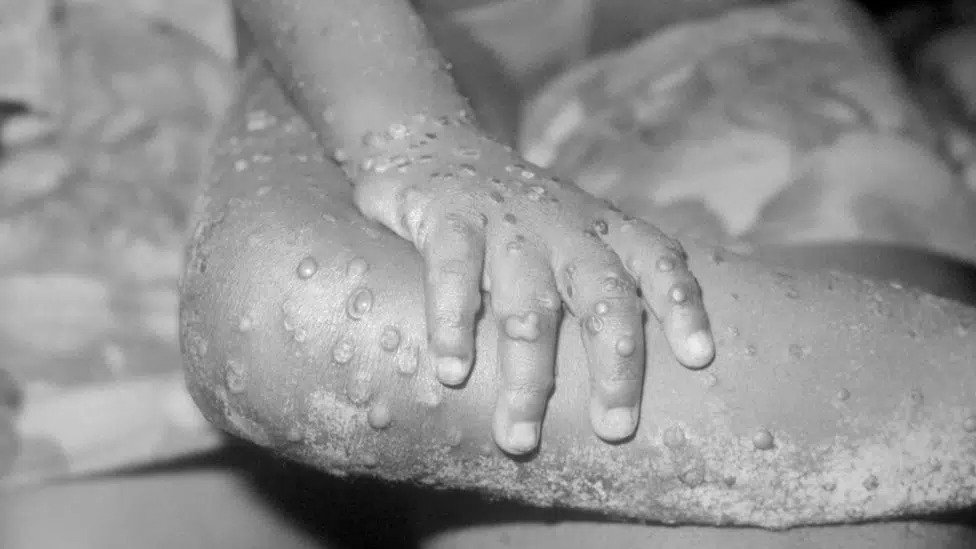 SZO: Potvrđeno 80 slučajeva majmunskih boginja u 11 zemalja