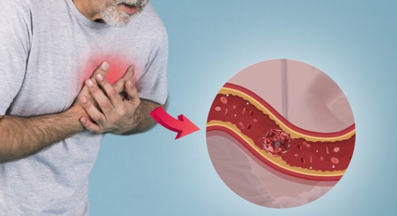 Simptom koji mnogi zanemaruju može ukazivati na problem sa začepljenim arterijama